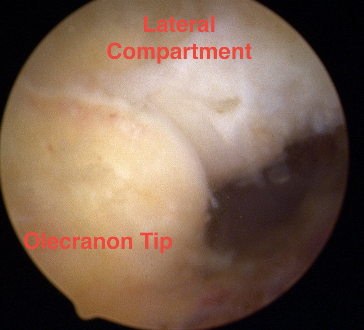 Elbow Arthroscopy Posterolateral